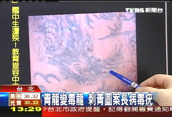 青龍變毒龍 刺青圖案長病毒疣