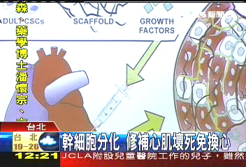 治「心肌梗塞」　注射幹細胞有救