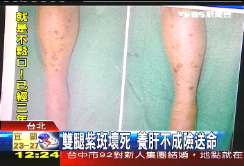 喝未熟蜆湯　男子染海洋弧菌截肢