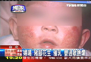 〈獨家〉婦喝「豬腳花生」催乳　嬰過敏臉爛
