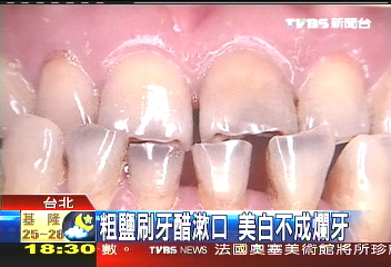 粗鹽刷牙醋漱口 美白不成爛牙
