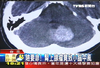 險要命! 腎上腺瘤竟致小腦中風