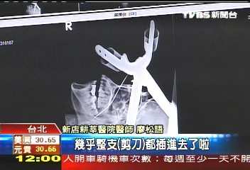 修剪藤蔓不慎墜梯 大剪穿眼刺腦