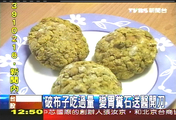 破布子吃過量　變胃糞石送醫開刀