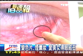 變色片、煙燻妝 愛美女得眼結石