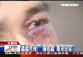 蟲蟲危機! 「隱翅蟲」毒液毀容