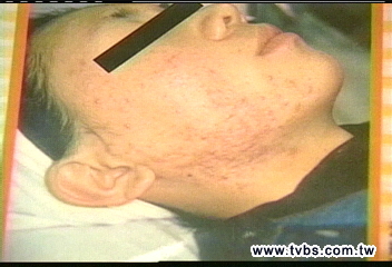 一瓶2用？　瘦身霜抹臉紅腫潰瘍