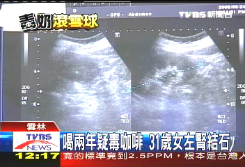 自稱喝2年疑毒咖啡 31歲女腎結石