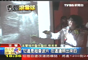 母女驗出腎結石　疑喝蒙牛引起