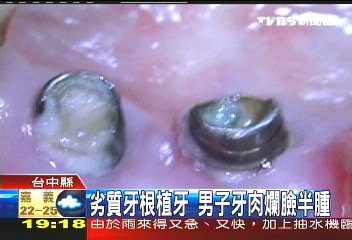 劣質牙根植牙　男子牙肉爛臉半腫