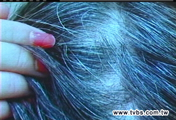 號稱天然染髮劑　婦人使用掉髮