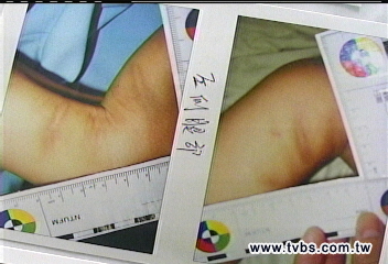 腦出血全身傷 3歲男童疑遭虐命危