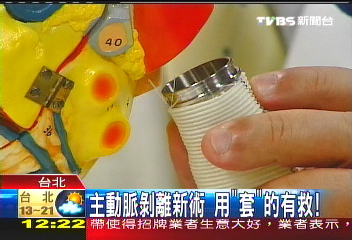 主動脈剝離新術 用「套」的有救!