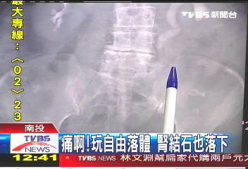 痛啊!玩自由落體 腎結石也落下