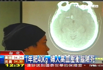 1年肥40Kg 婦人高血壓衝腦險死