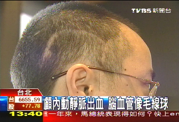 顱內動靜脈畸形　37歲奶爸險喪命