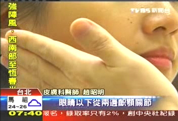 省錢愛美有新招　微整形保養興起