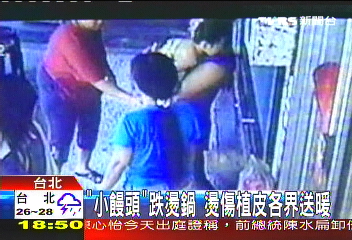 「小饅頭」跌燙鍋　燙傷植皮各界送暖