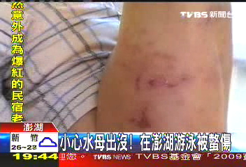 小心水母出沒　在澎湖游泳被螫傷