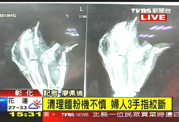 清理麵粉機不慎　婦人3手指絞斷