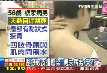 刮痧破皮遭感染　糖尿病男7天不治