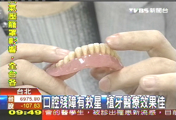 齒牙動搖非老嫗 牙周炎導致