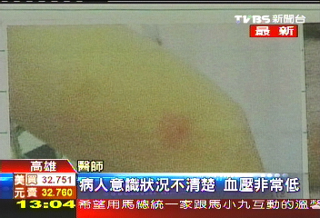 摘龍眼遭蜂螫 男昏迷送醫搶救
