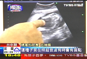 〈獨家〉唐氏寶寶早產 產檢未發現還少條腿