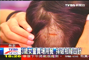 3歲女童賣場用餐 摔破相縫4針
