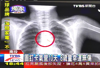 〈獨家〉圖釘卡氣管10天　8歲童幸運無傷