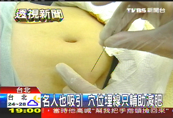名人也吸引　穴位埋線只輔助減肥