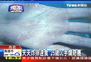 〈獨家〉天天炸排速食　25歲OL手爛奇癢