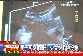 雙子宮發育畸形 少女懷胎險沒命