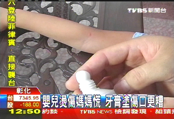嬰兒燙傷媽媽慌　牙膏塗傷口更糟