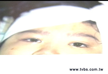 開刀除瘤女童嘴歪無法闔眼　怒控醫師