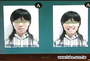 睡坐姿勢不正確　小女童臉歪嘴斜