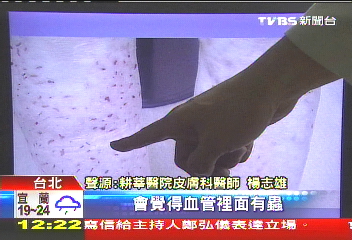 皮膚有蟲？針挑、刀刮　「妄想」作祟