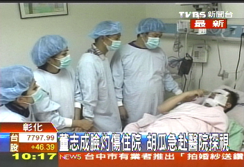 錄影做噴火效果 藝人小董臉灼傷