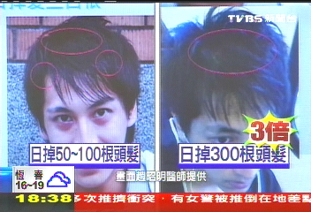 狂用滋潤洗髮精 型男落髮像七旬翁