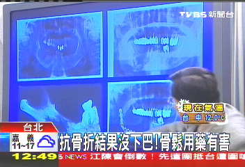 抗骨折結果沒下巴！　骨鬆用藥有害