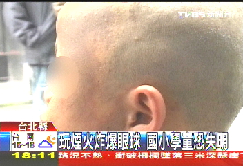 玩煙火炸爆眼球　國小男童恐失明