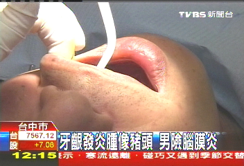 牙齦發炎!腫像豬頭 男險腦膜炎