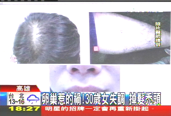 卵巢惹的禍！30歲女失調　掉髮禿頭
