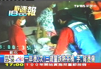 一年燙2次!3歲童跌熱茶桶 手、背燙傷