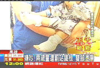 嫌吵！2歲童遭罰站鐵板　雙腳燙傷