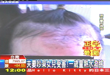夫妻吵架女兒受害！　1歲童熱水潑臉