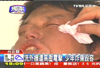 〈獨家〉洗外牆遭高壓電擊 少年炸傷毀容