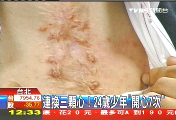 連換3顆心! 24歲少年「開心7次」