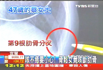 咳不癒要小心！　骨鬆女竟咳斷肋骨