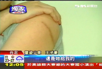 「讓我見兒子」 王子豪秀傷疤控妻